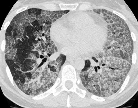 间质性肺疾病看病经验分享,分享肺腺癌临床实验的例子