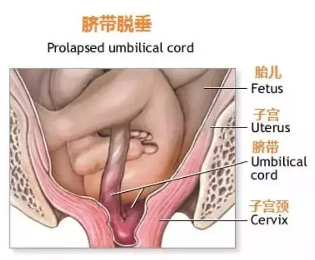 她破水后差点失去了宝宝,幸好没耽误1分钟!