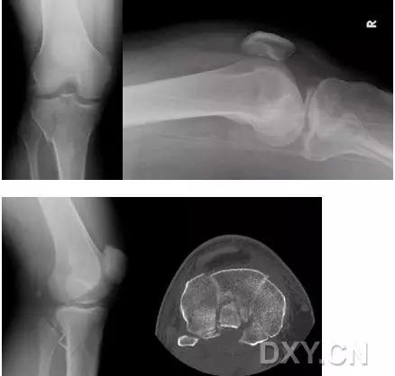 特殊骨折类型,特殊骨折体征
