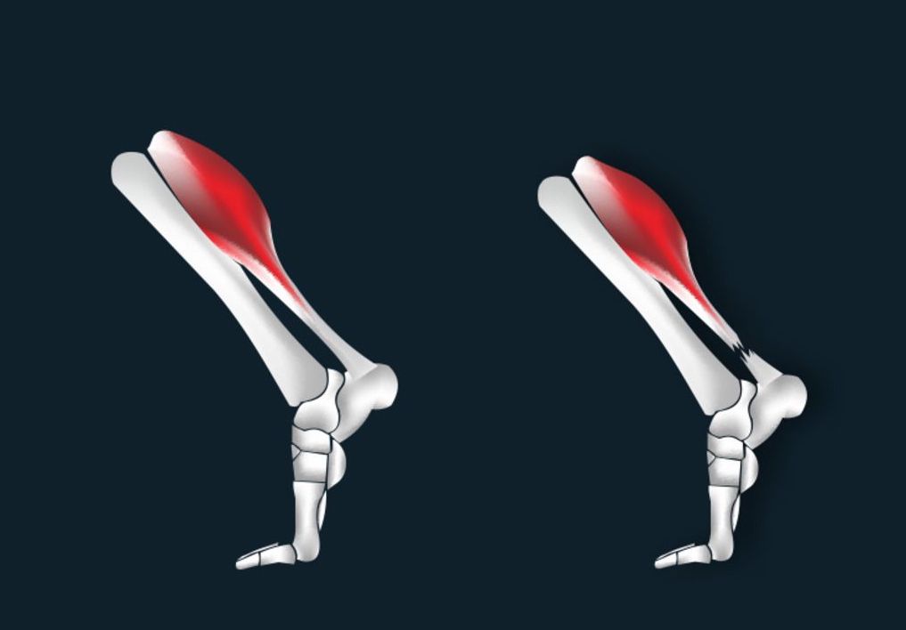 跟腱炎如何预防,跑步的危险