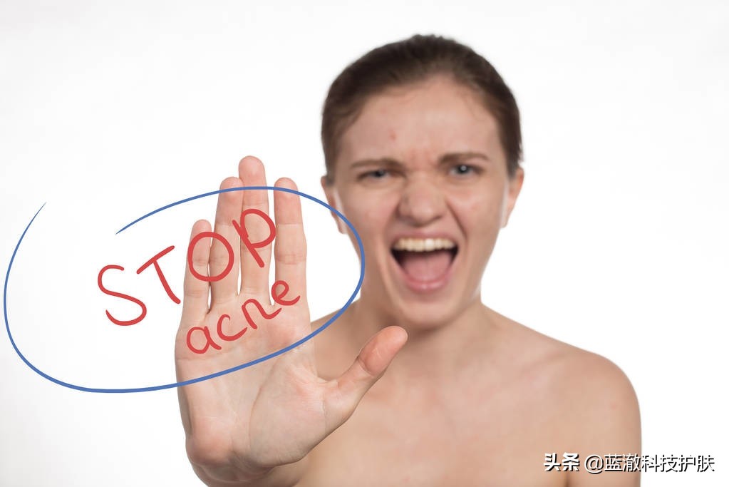 黑头太顽固教你去黑头的方法,去黑头的小窍门视频