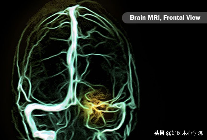 最常见的血栓类型是,最致命血栓视频