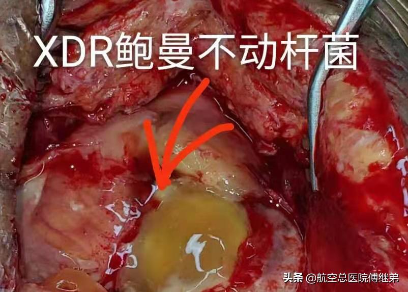 鲍曼不动杆菌多重耐药血液感染,鲍曼不动杆菌感染死亡率