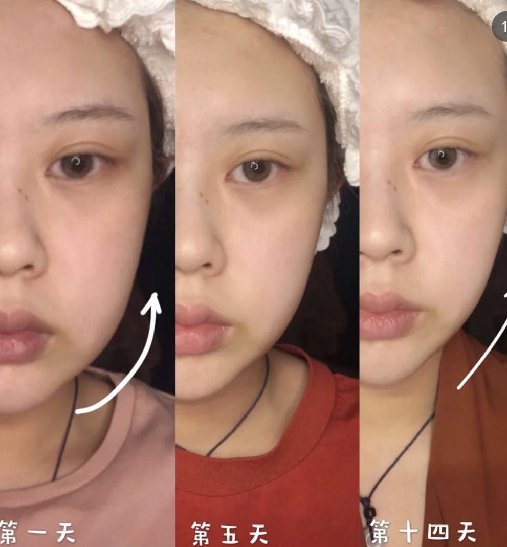 美容面部紧致提拉全过程,怎么做面部提拉改变大小脸