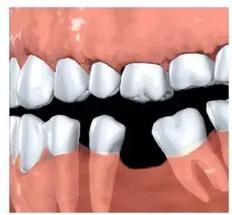 医生说我少一颗牙怎么回事,医生说我少了一颗牙