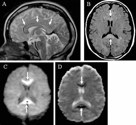 胼胝体有什么症状,胼胝体形态较小可以治疗吗
