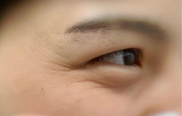 马应龙去除眼纹,马应龙去细纹