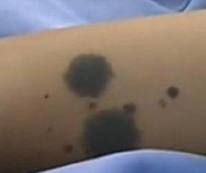 你身上有色素痣吗,你身上的痣有什么含义图片