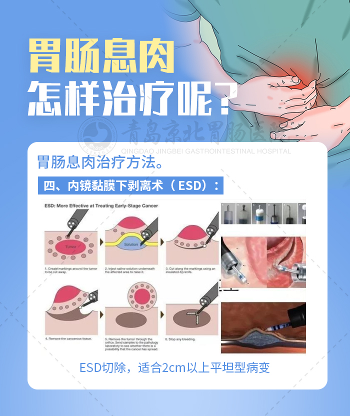 胃肠镜发现有息肉严重吗,肠镜多大息肉可内镜下切除