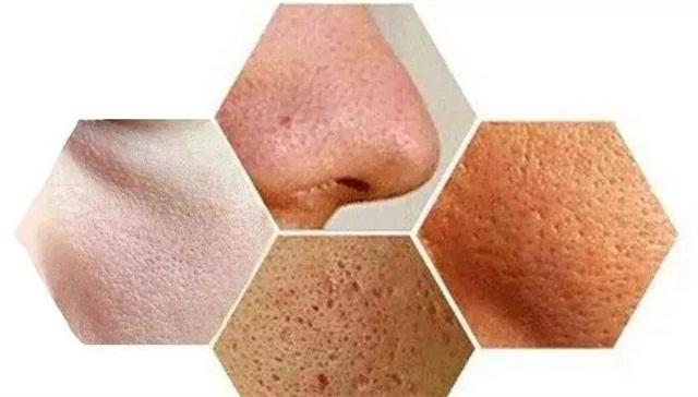 毛孔粗大怎么办最有效收缩毛孔,毛孔粗大怎么办怎么有效收缩毛孔