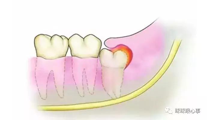 害怕恐惧拔智齿打麻醉,害怕拔智齿打针怎么克服