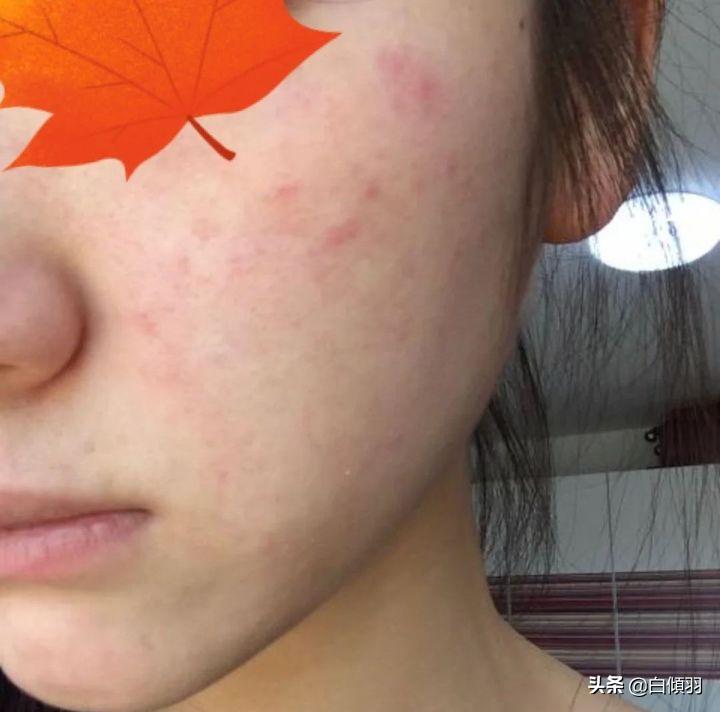 红肿痘痘不疼了但是还是有包,红肿痘痘摸着软软的一直不冒白头