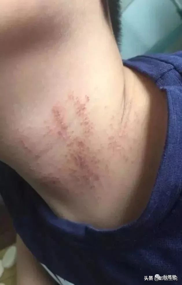 治疗皮肤瘙痒的中医有效便方