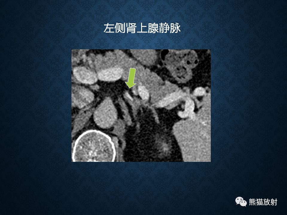 纵隔和肾上腺恶性肿瘤,纵隔性肿瘤位置图