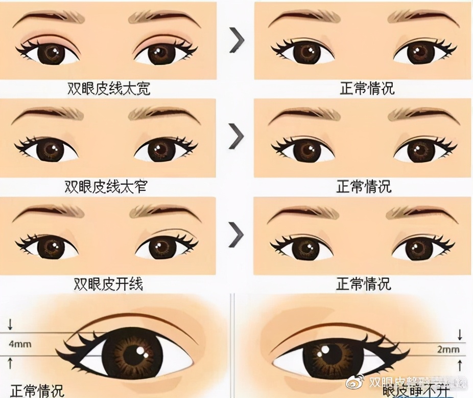 双眼皮一宽一窄修复视频,全切双眼皮修复宽改窄