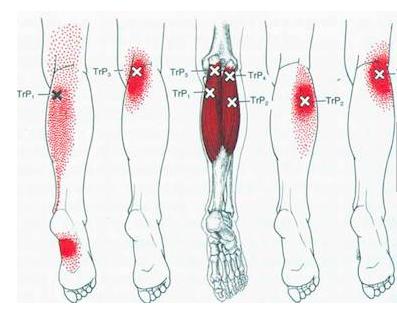 膝关节腘窝疼痛的锻炼方法,腘窝疼痛连带大腿小腿肌肉痛