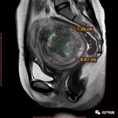 微波消融治疗子宫肌瘤,微无创治疗技术