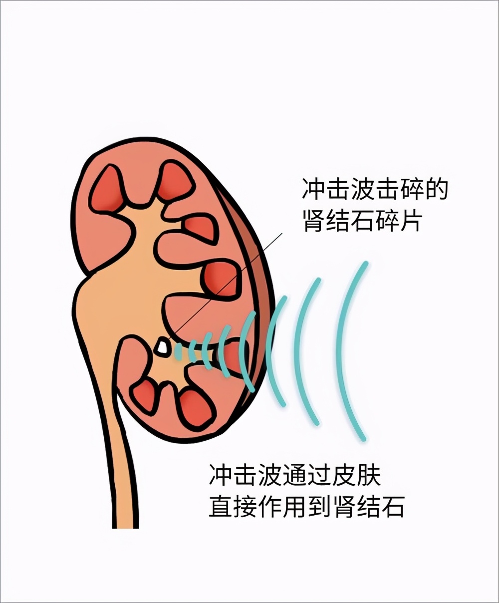 为什么肾结石掉下来肾里还有结石,肾下盏结石排石的正确方法