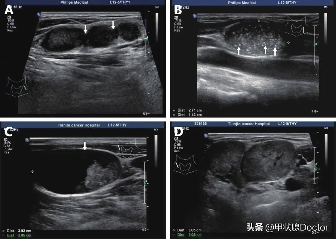 甲癌淋巴结转移颈部全切脸会肿,甲癌淋巴转移多少要做碘131