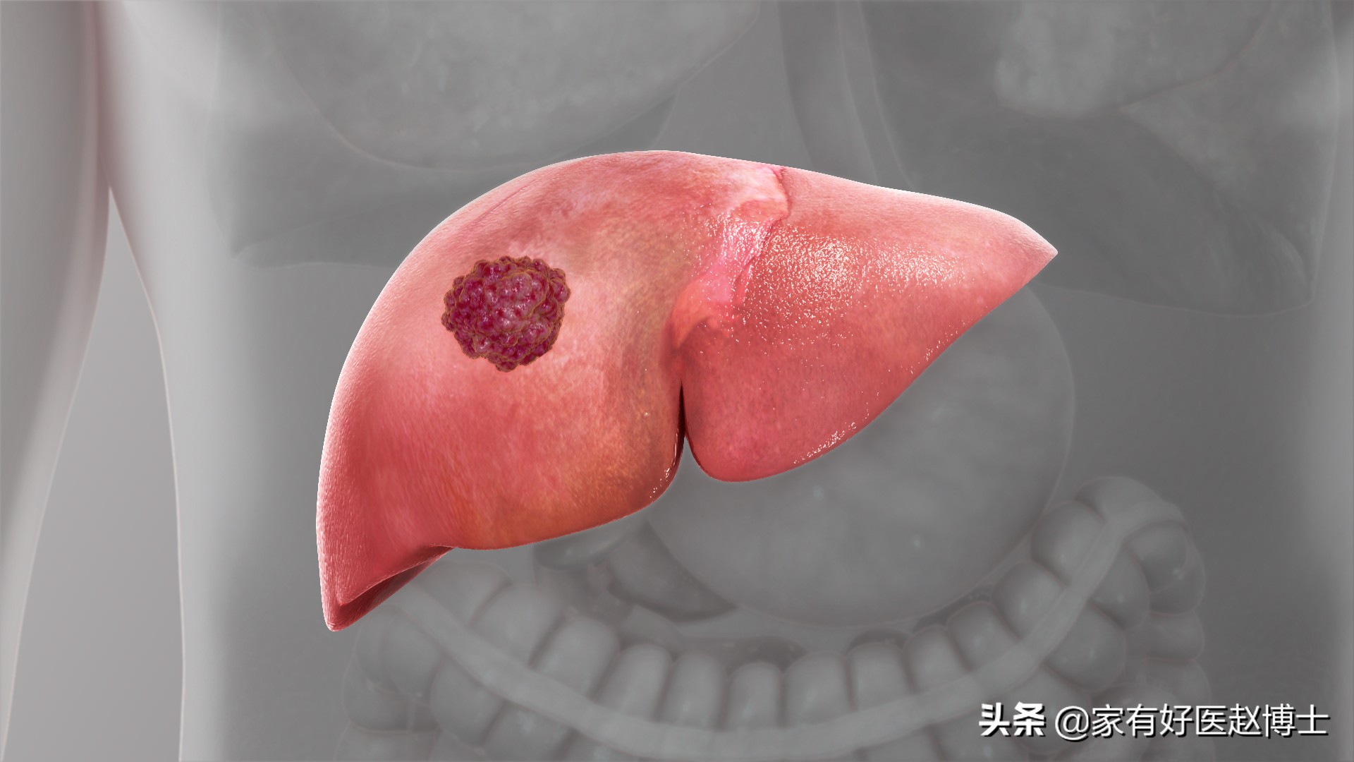 六大高发癌症早筛攻略,六大癌症有哪些