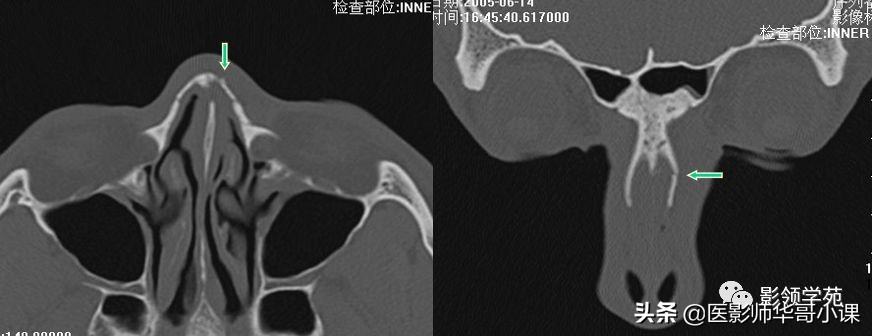 「鼻骨彩图」鼻骨CT解剖及骨折影像学诊断