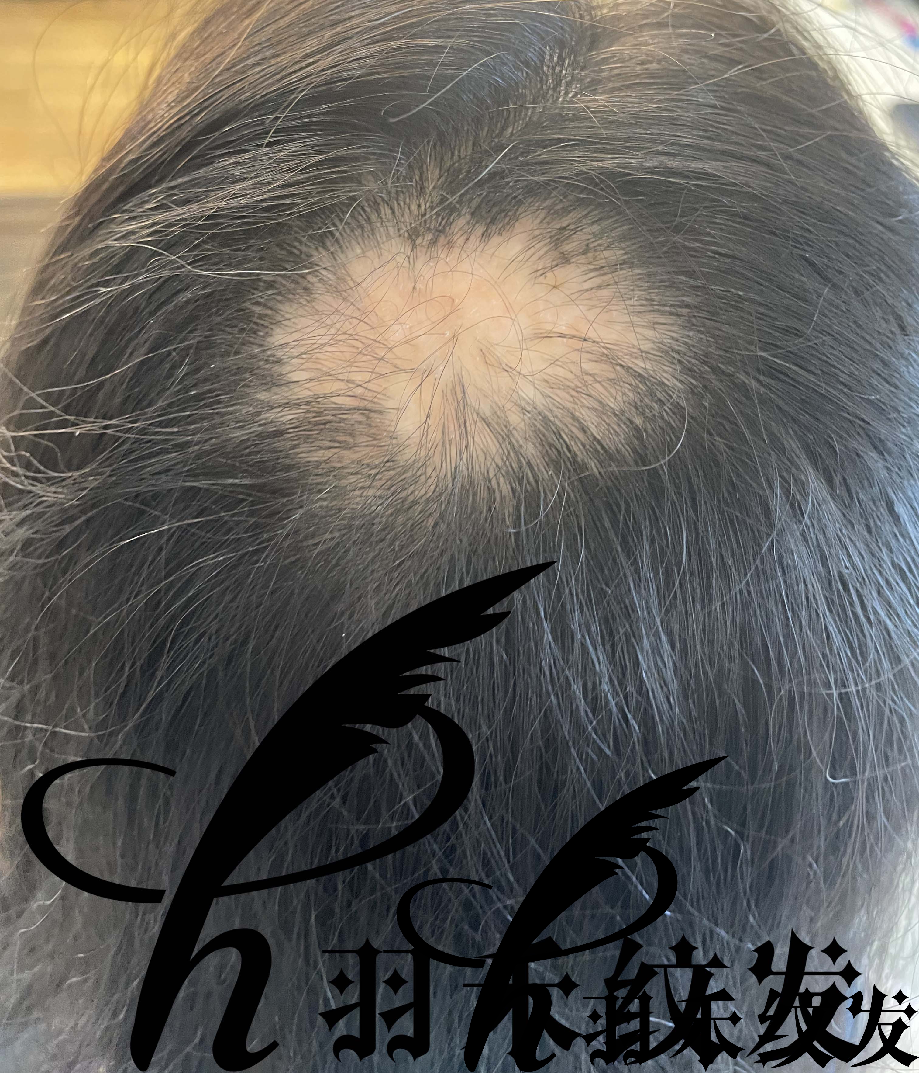 濂冲＋澶撮儴浼ゅ彛濡備綍鍖呮墡,濂冲＋澶撮儴浼ゅ彛缁峰甫鍖呮墡瑙嗛