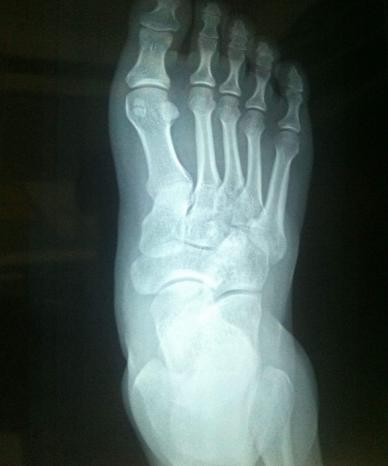 打篮球崴脚了怎么处理,打篮球崴脚脱鞋捏脚