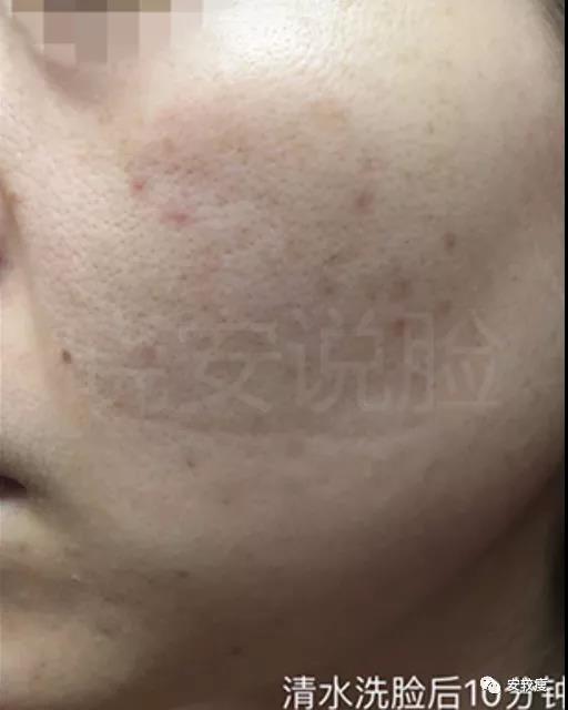 外油内干敏感痘肌怎么护肤,30岁油皮痘痘敏感肌怎么改善
