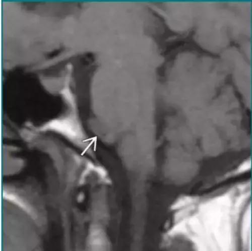 各种囊肿的症状,颅内囊肿18-19mm严重吗