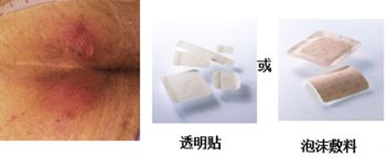 压疮敷料的选择及使用,褥疮敷料的正确使用方法