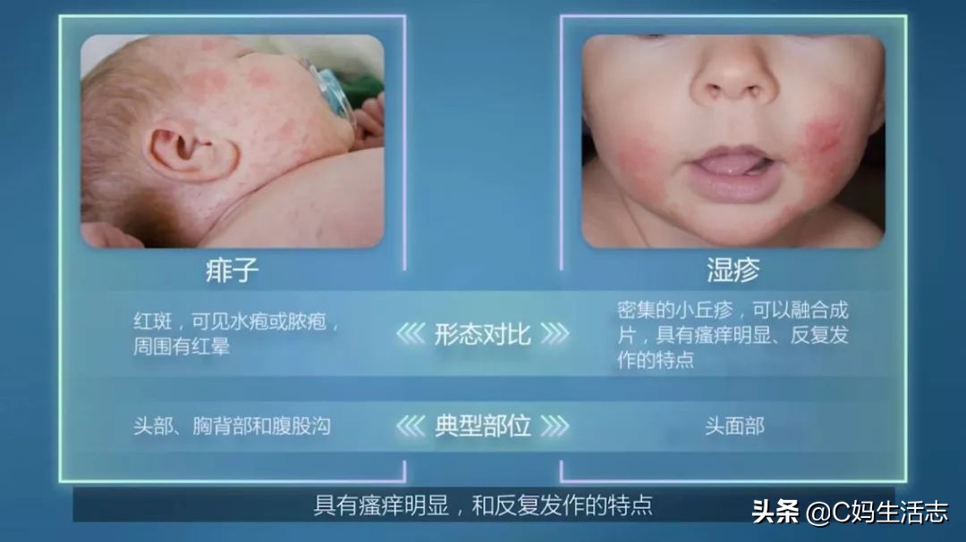 长痱子怎么办小妙招,夏天长痱子有什么食疗方法