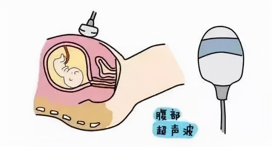 被大多数孕妈忽视的宫颈机能不全