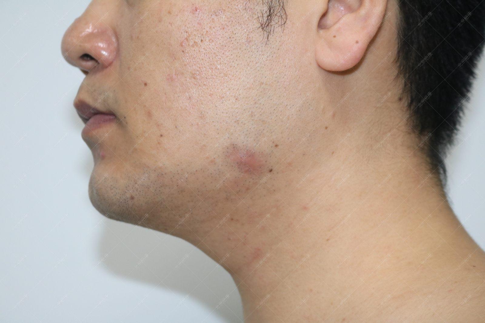 疤康疤痕疙瘩治疗效果怎么样,疤康治疗效果是真实的吗