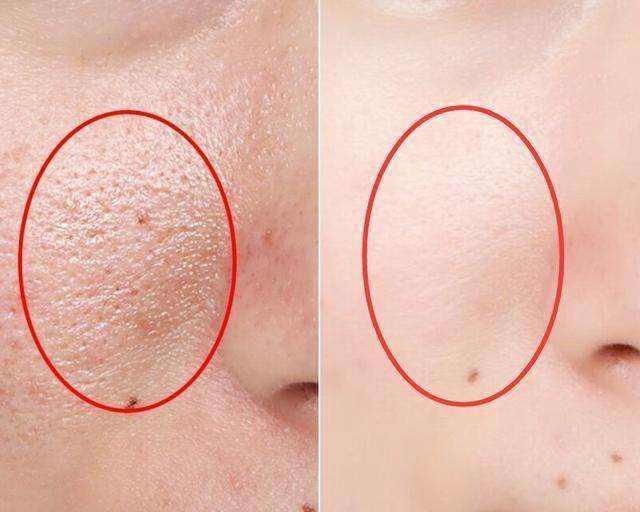 毛孔粗大到底怎么有效解决,毛孔粗大有哪几种类型