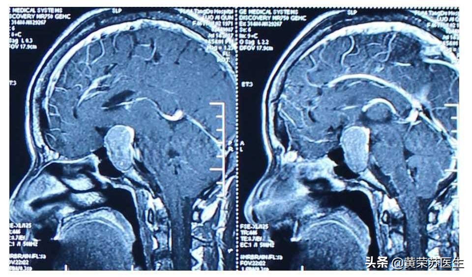 妊娠合并肿瘤怎么处理,妊娠合并甲状腺恶性肿瘤