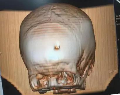 男孩摔到后脑勺做开颅手术,娃儿头骨摔断做开颅手术