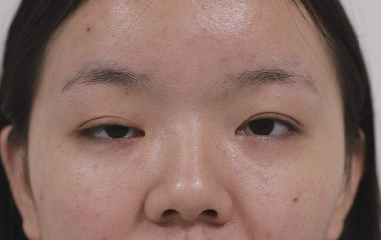 割双眼皮是种什么体验,割双眼皮什么样子才是增生