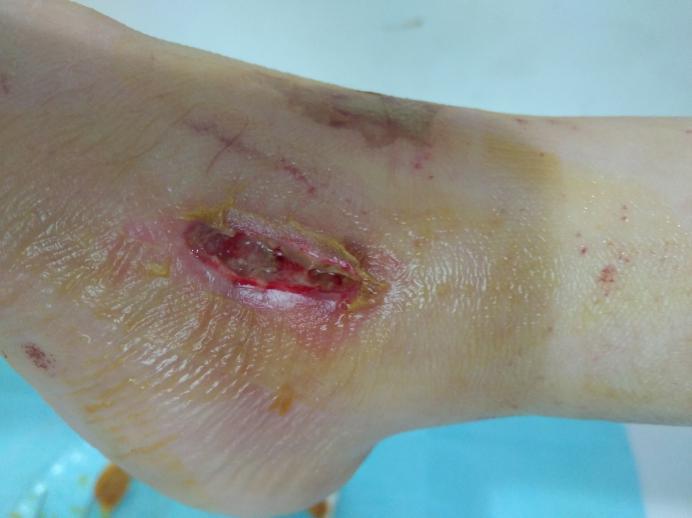 术后伤口要祛疤膏吗,术后伤口拆线后伤口好周围红