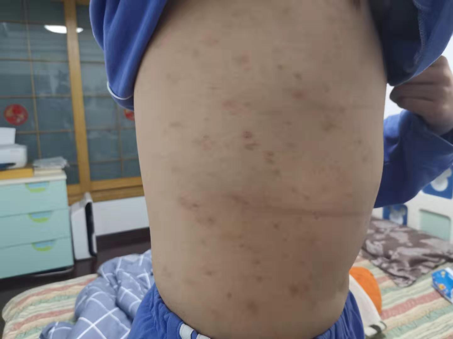 中医治疗皮肤痒的最好方法,中医治疗皮肤纤维瘤