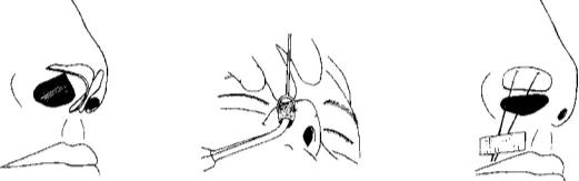 鼻道狭窄引起呼吸困难,先天性鼻道狭窄
