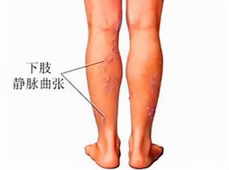 下肢静脉淤积性溃疡,下肢静脉性溃疡挂哪个科