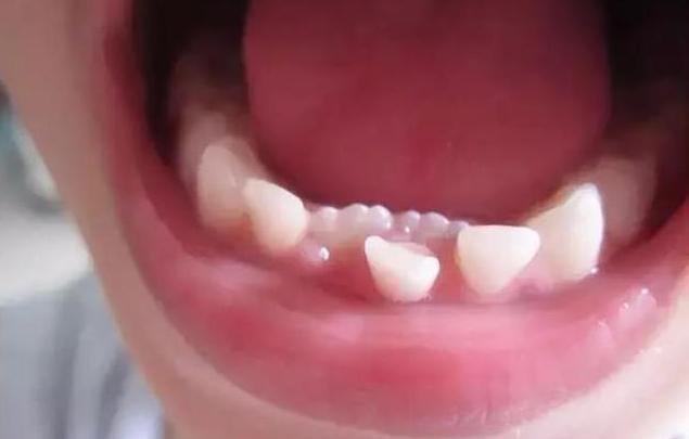 为什么孩子掉牙后没长出来,为什么孩子6岁就掉牙了