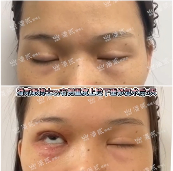 上睑下垂手术是不是永远闭不上眼,做了上睑下垂手术后怎么护理眼睛