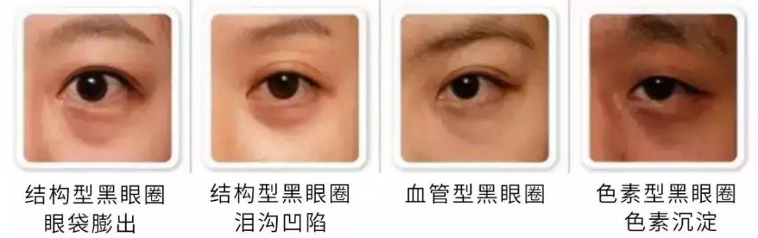 咖啡因淡化什么类型黑眼圈,黑眼圈三种类型你属于哪种