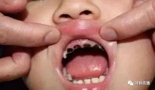 奶瓶龋对婴幼儿牙齿损害有多大,奶瓶龋主要发生在哪颗牙齿