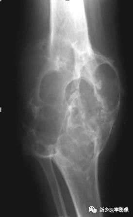 骨骼坏死最佳治疗方法,骨骼疾病治疗