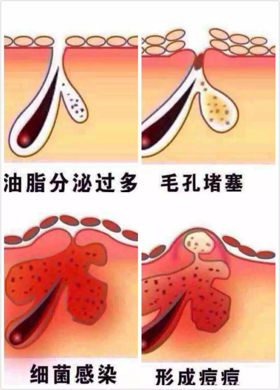 脑门痘痘反复无常,反反复复的痘痘用什么办法