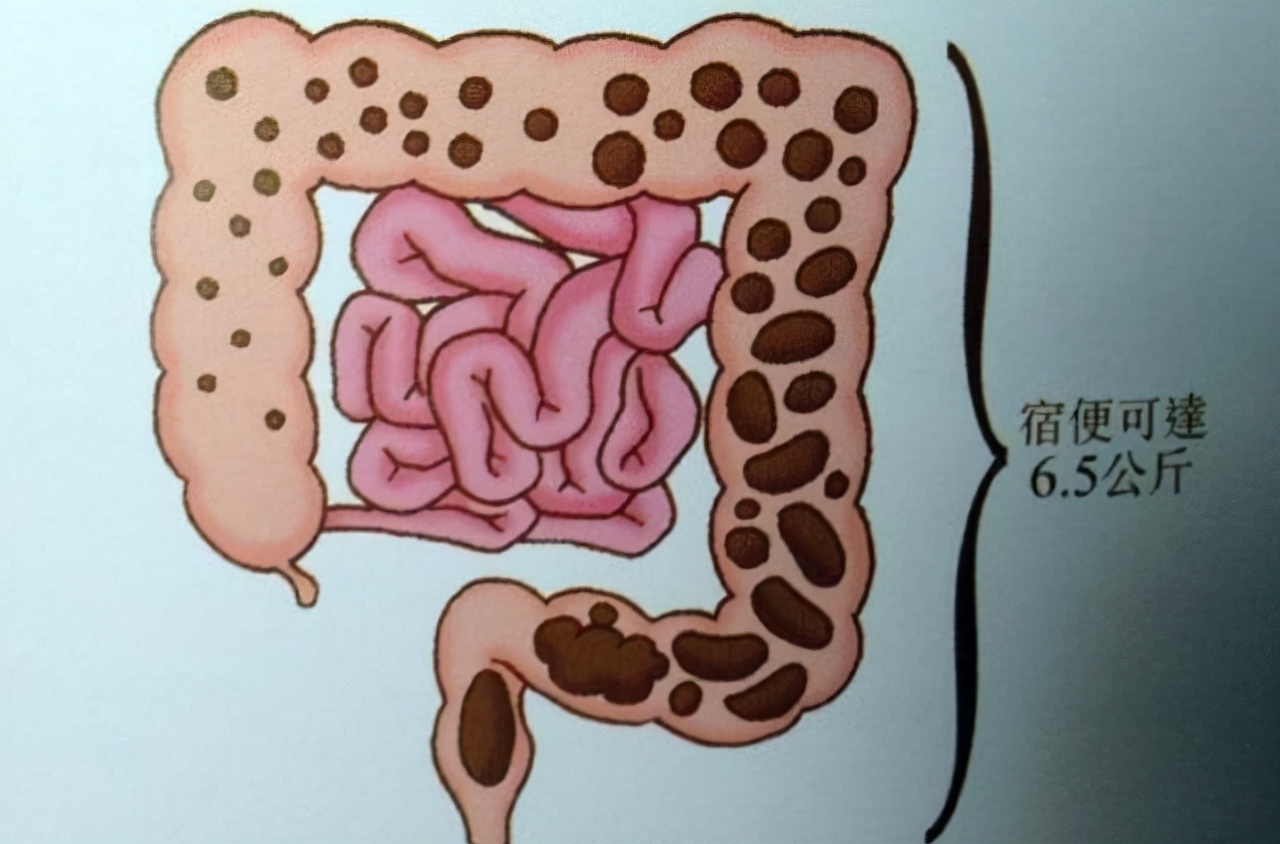 人体内真有6公斤宿便吗？怎么才能排出那些“赖着不走”的宿便？