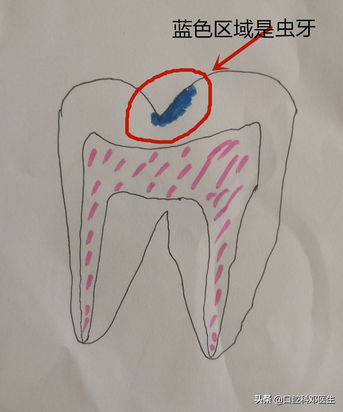 上排虫牙补牙全过程,虫牙补牙疼怎么办