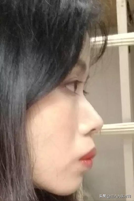 2周岁龅牙可以矫正吗,微龅牙整完后悔吗